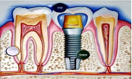 种植牙