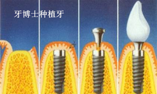 种植牙