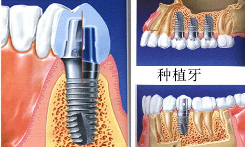种植牙
